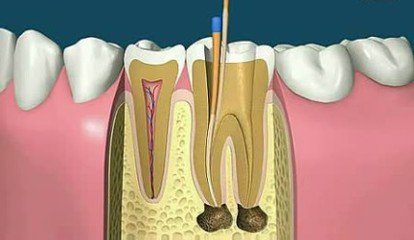 根管的治疗的费用