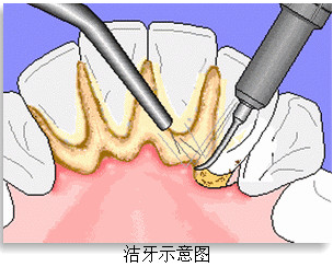 洗牙