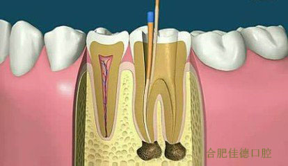 龋坏怎么治疗