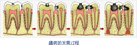 龋坏