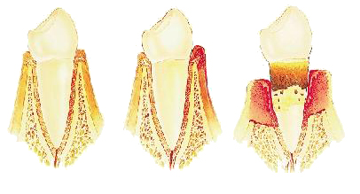 合肥牙周炎都有哪些症状