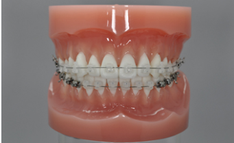 合肥牙齿矫正的方法