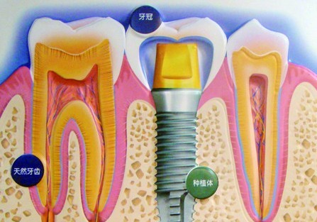 合肥佳德口腔种植牙