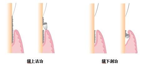 合肥佳德口腔牙周炎